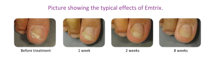 Emtrix Fungal Nail Treatment 10ml UpbeatCare UK